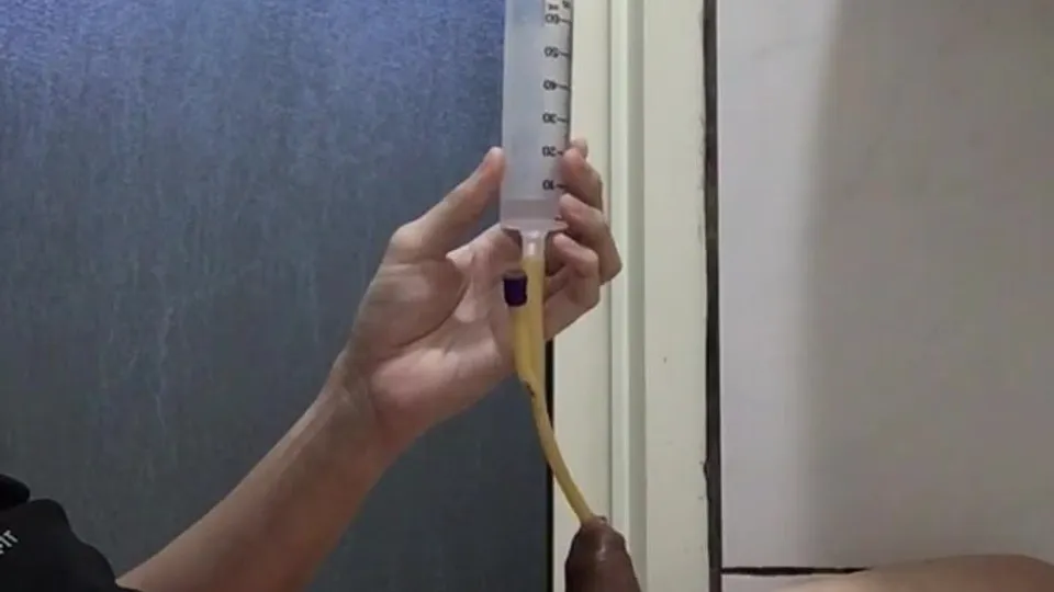 Expanding bladder with 1000mL saline - ThisVid.com